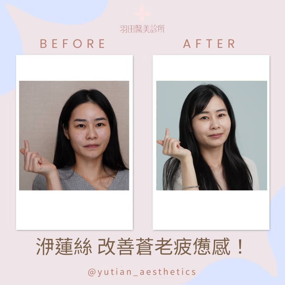 洢蓮絲拉提案例分享