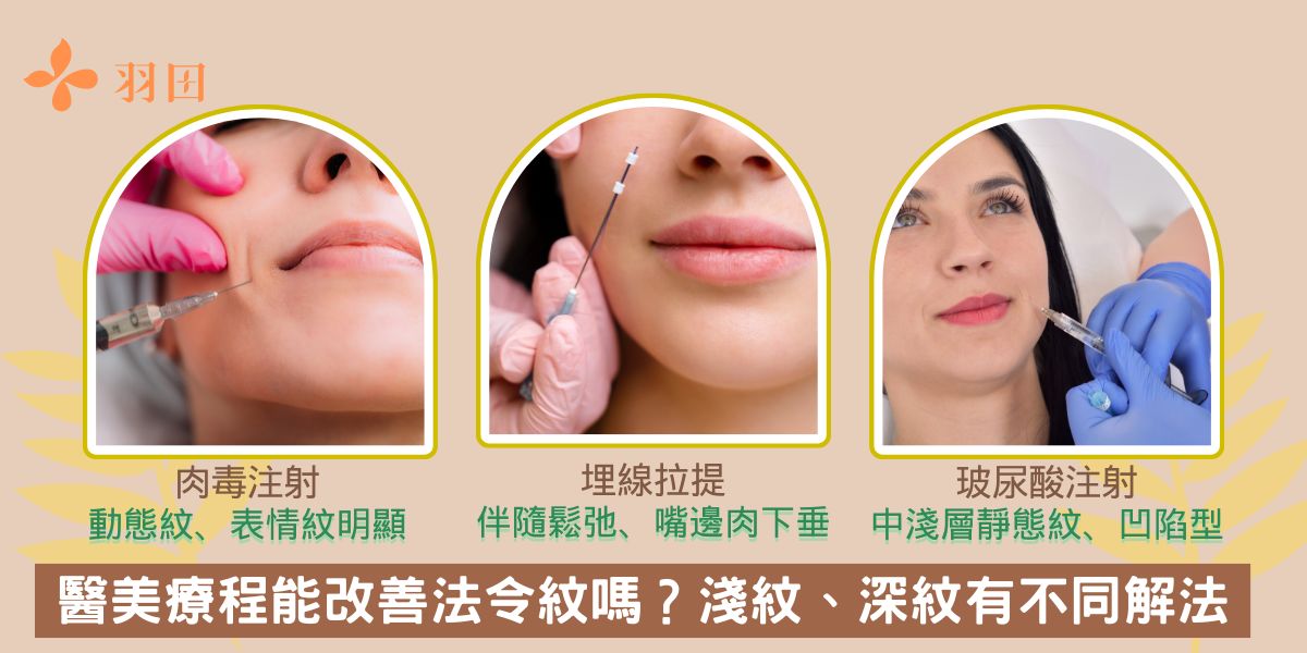 醫美療程能改善法令紋嗎?淺紋、深紋有不同解法