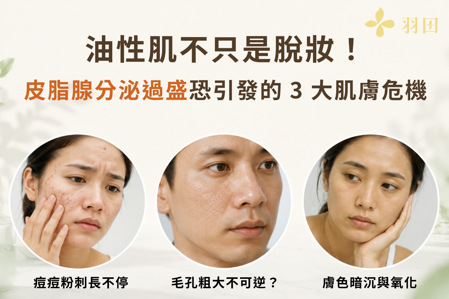 油性肌膚危機示意圖，說明皮脂腺分泌過盛造成痘痘粉刺、毛孔粗大與膚色暗沉三大問題