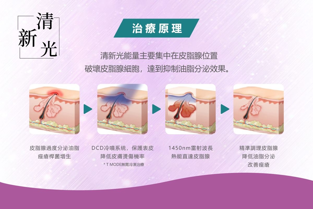 清新光治療原理示意圖，皮膚剖面依序說明皮脂腺過度分泌、DCD 冷噴保護表皮、1450nm 雷射熱能直達皮脂腺、精準調理降低油脂分泌
