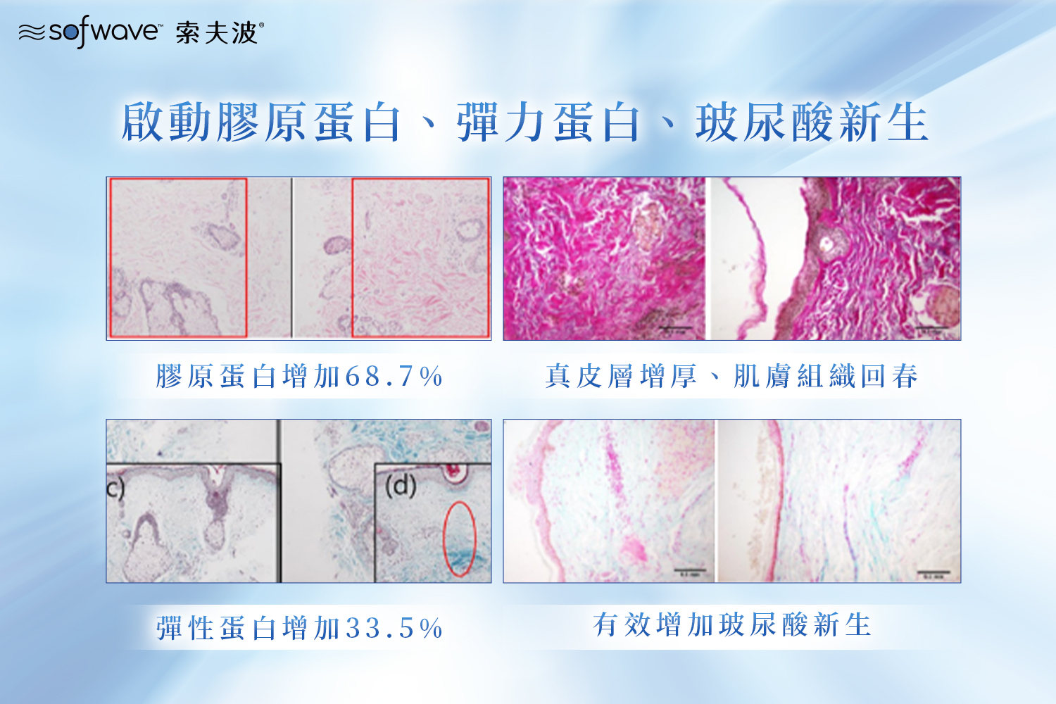 索夫波治療前後的皮膚組織切片對照,顯示膠原蛋白增加 68.7%、彈性蛋白增加 33.5%