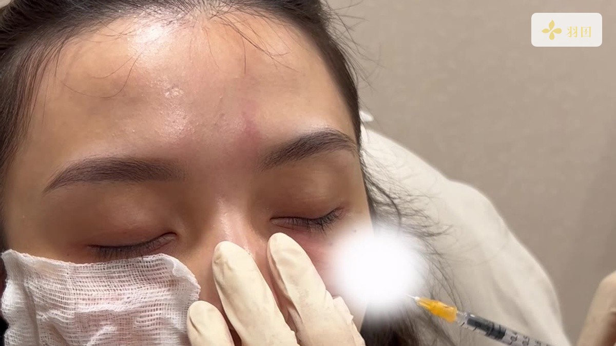 醫師以紗布保護眼周,在個案眼下進行注射